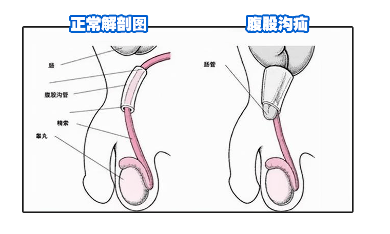 腹股沟斜疝解剖图图片