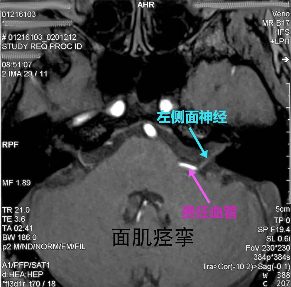 常見於顱腦腫瘤,腦血管疾病,顱腦ct檢查可以明確診斷