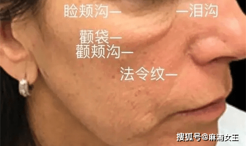 印第安纹老师不会告诉你这些秘密,去除印第安纹需要注意7件事_颧骨