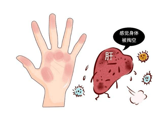 手掌发红就是肝掌?别瞎猜了,听听医生怎么说_肝脏_代谢_患者