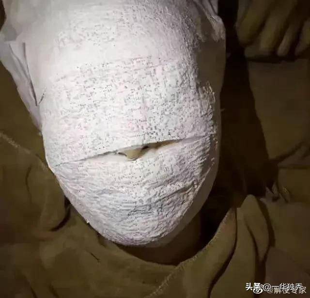 网曝照片:林志颖手术后头部缠满绷带医生说他的脸骨碎裂是因安全