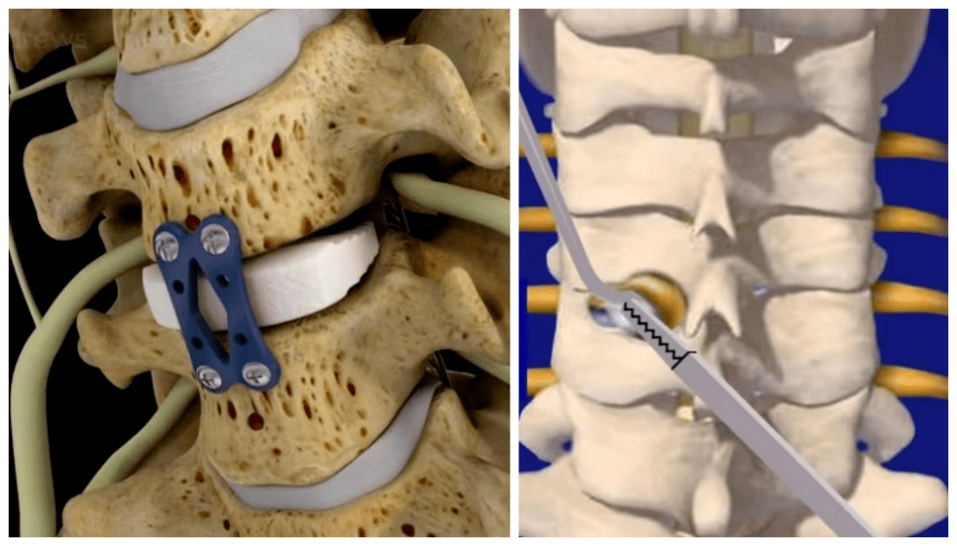 颈肩疼痛 手麻无力 可能是神经根型颈椎病在作祟!_患者_手术_椎间盘
