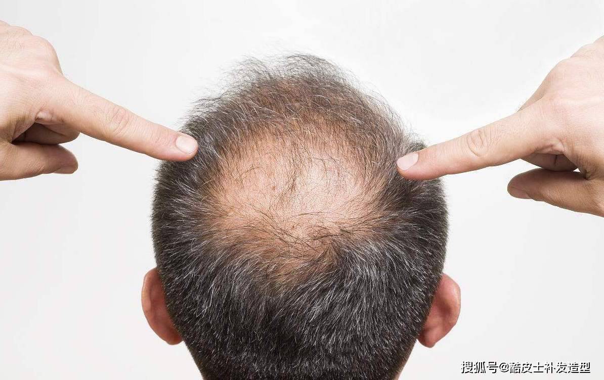 还可以增强假发佩戴的持久性,防止假发粘合剂对头皮的刺激,并缓解已经