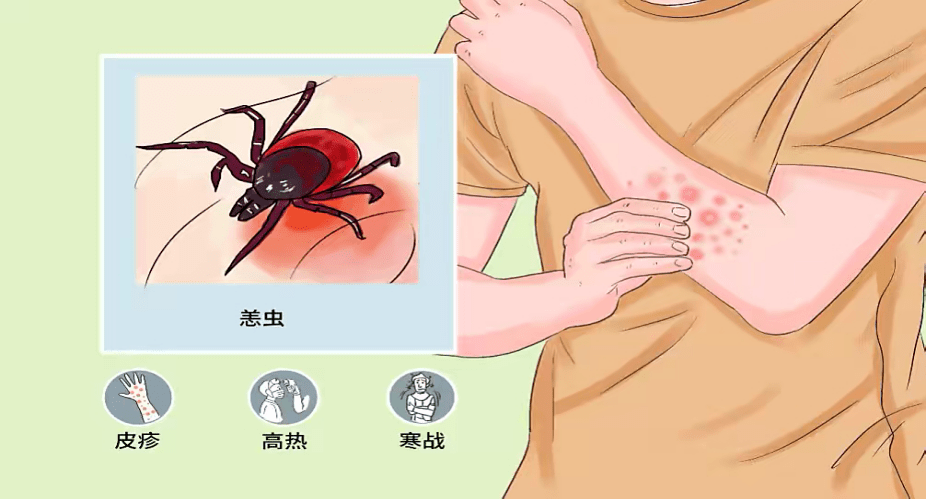 恙虫病也叫丛林斑疹伤寒,是由恙虫病东方体所引起的自然疫源性疾病.