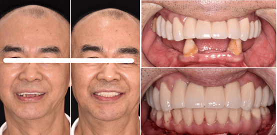 "为即刻而生"百齿泰博贝尓系列种植牙系统首发仪式在湘启动_医疗_口腔