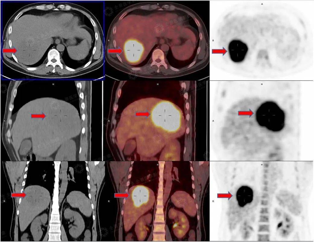 肝占位性病变可能是良性,也有可能是恶性,全景医学影