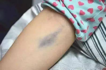 静脉抽血后紫了一大块,止血的"4大误区"你躺枪了吗?_患者_出血点_针眼