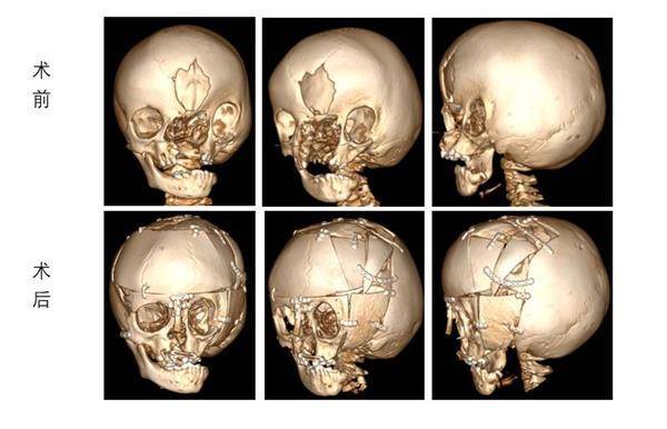 西西的头颅ct三维重建显示,面部正中巨大裂隙伴鼻骨缺失,左侧颧骨