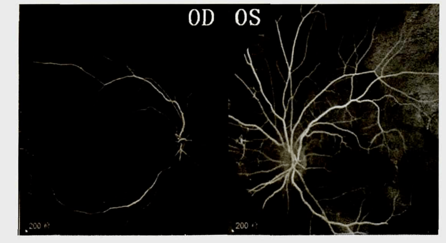 oct)oct检查能显示lhon各期患者的视网膜神经纤维层(retinalnerve