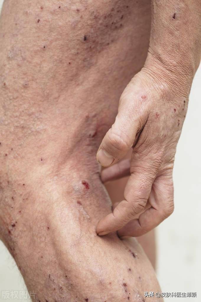 3,各种基础疾病导致的皮肤瘙痒症:很多慢性基础疾病,例如肿瘤,糖尿病