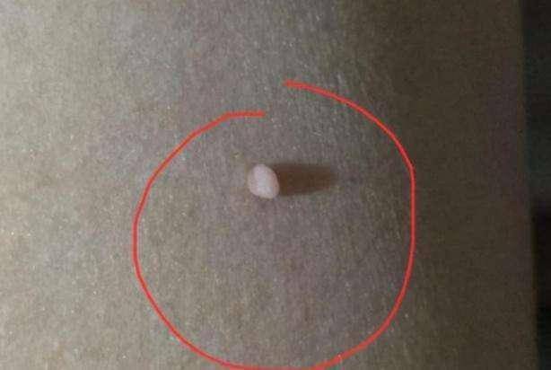 脖子和腋下的"小肉粒"是什么?能直接用手揪掉吗?