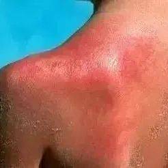 没有太阳也会被晒伤?专家提醒警惕“云层增强效应”_张倩_紫外线_天气