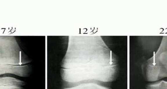 女性18歲前,男性20歲前,骨骺線閉合,基本不再生長.