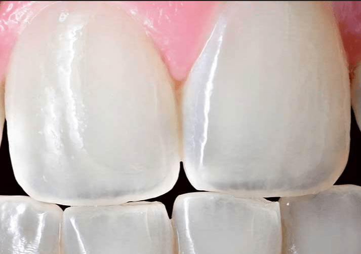 牙釉质到底能不能再生?