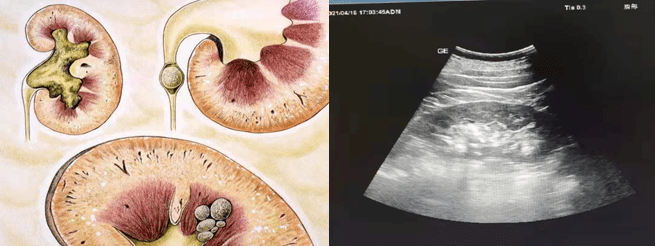 肾结石彩超图图片