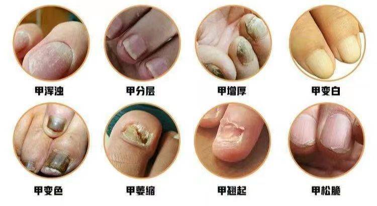 紧急扩散:全网度一份的灰指甲用药指南,不知道的赶紧收藏!