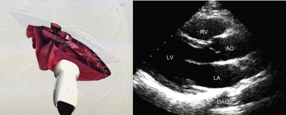 1. 胸骨旁左室长轴切面