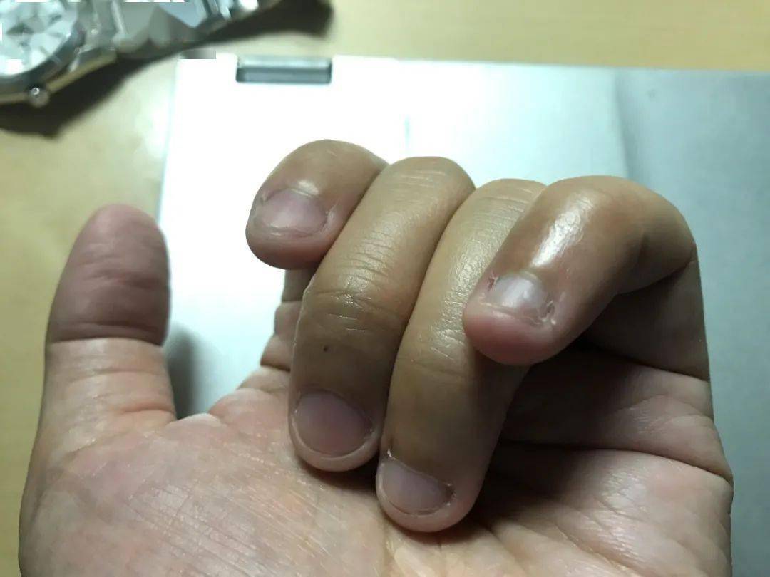 一,老茧和鸡眼有什么区别?