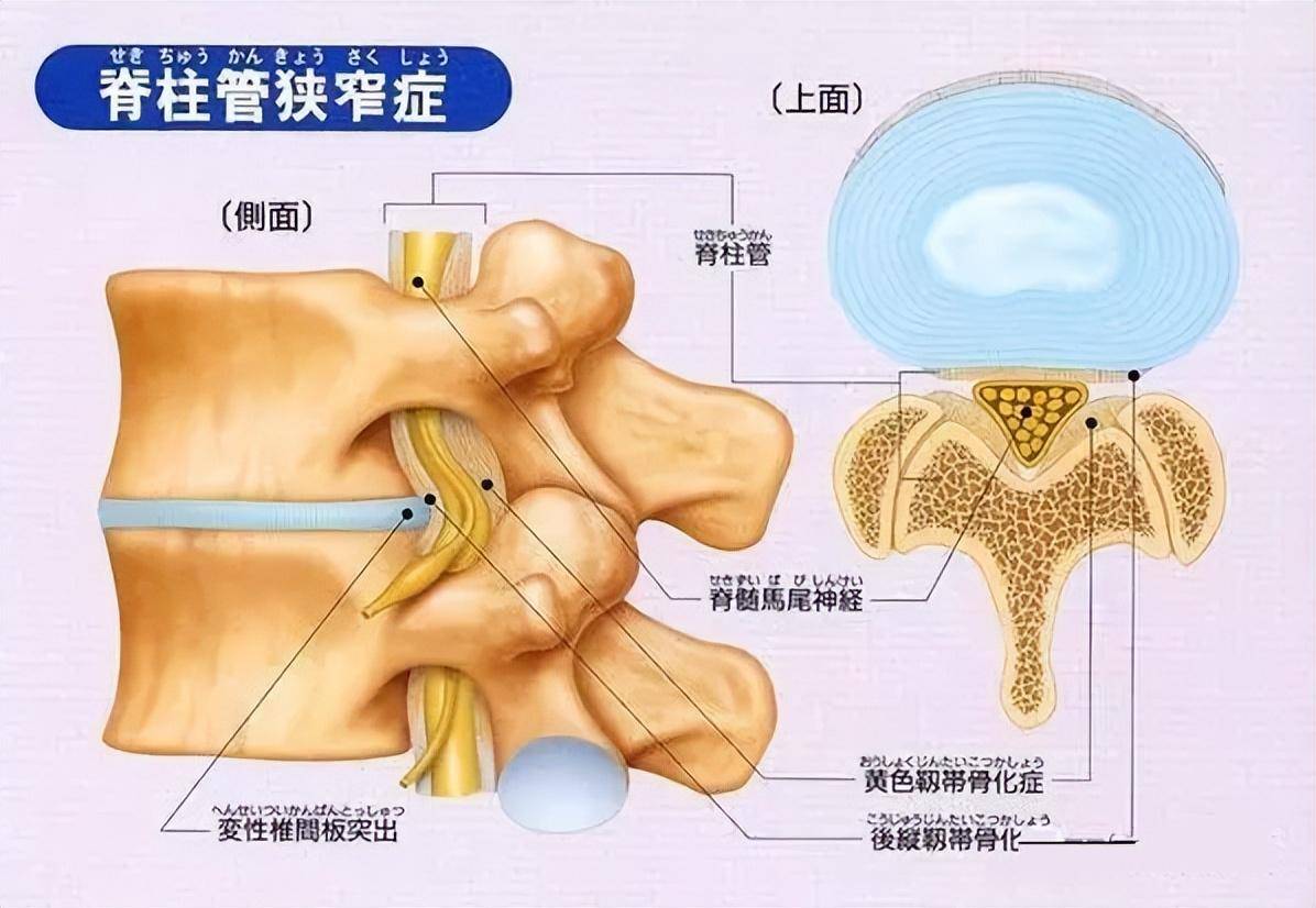 椎管狭窄出现在颈椎,胸椎,腰椎,症状相同吗?_患者_下肢_脊髓