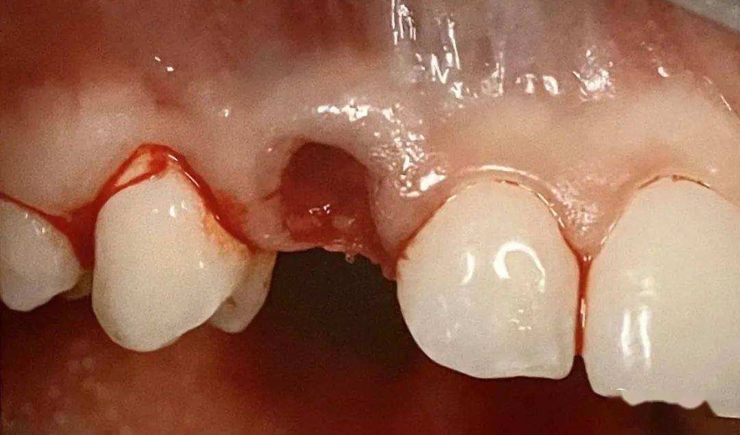 【病例分享】前牙美学区即拔即种手术