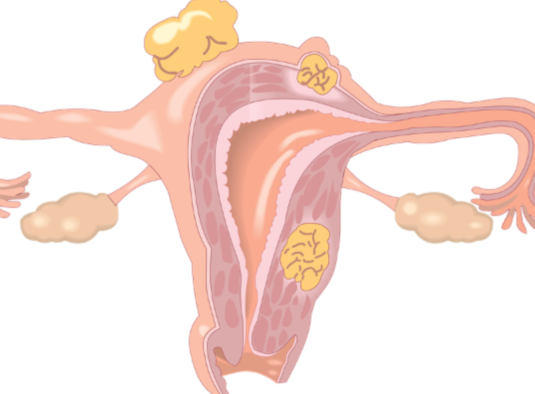 海扶刀隔山打"瘤"解决子宫肌瘤,助女子保住子宫_湖南_治疗_肿瘤