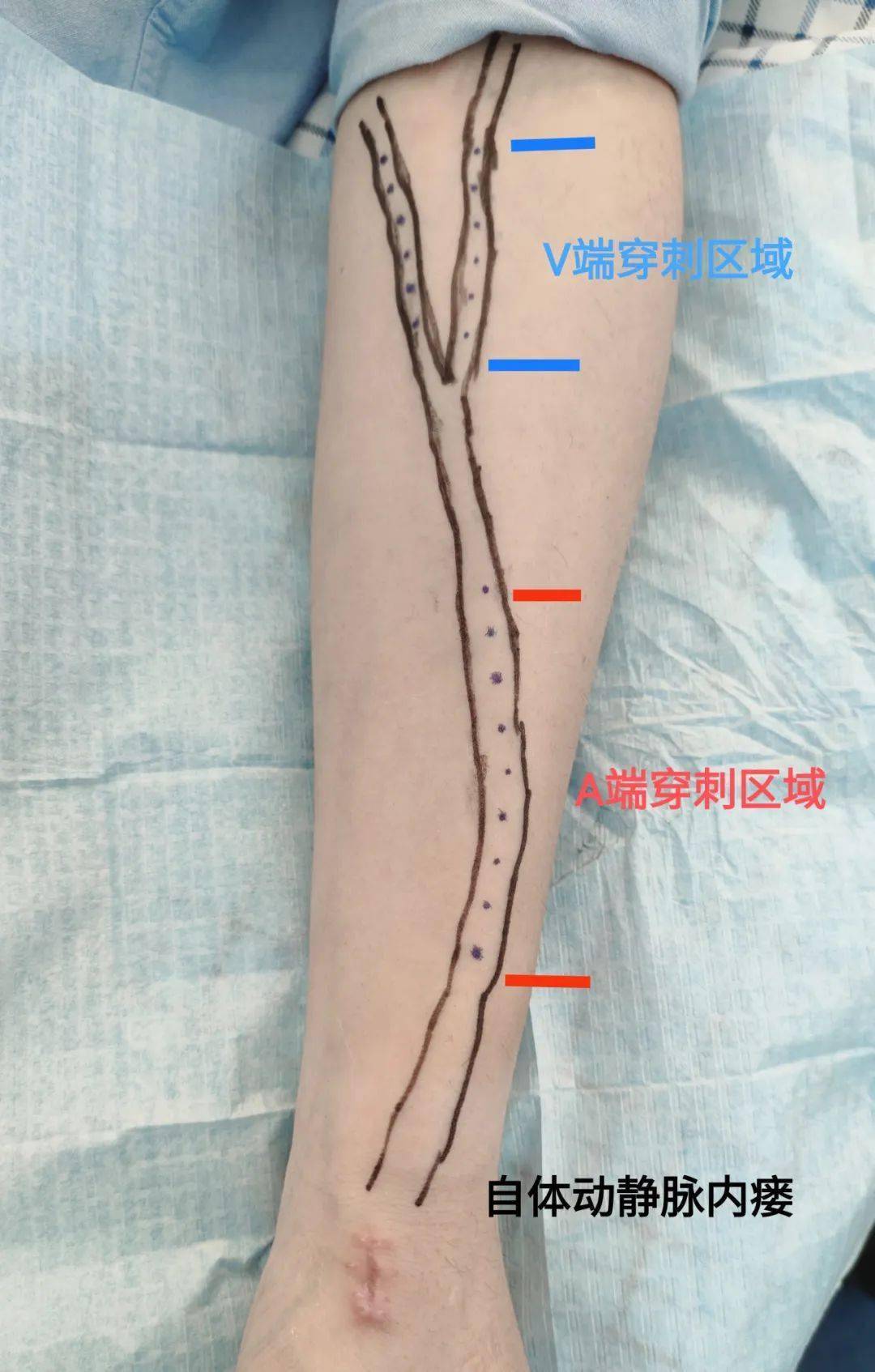 【积医科普】血管通路小组在行动——保卫血液透析患者生命线(一)