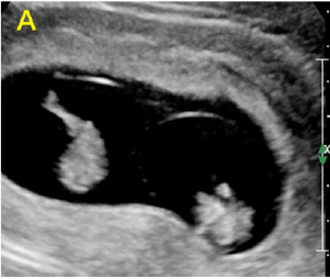 双胞胎胚胎b超图片图片