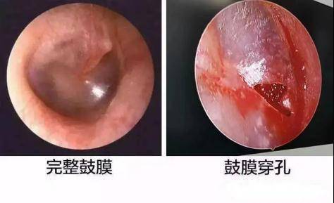 耳朵鼓膜充血图片图片