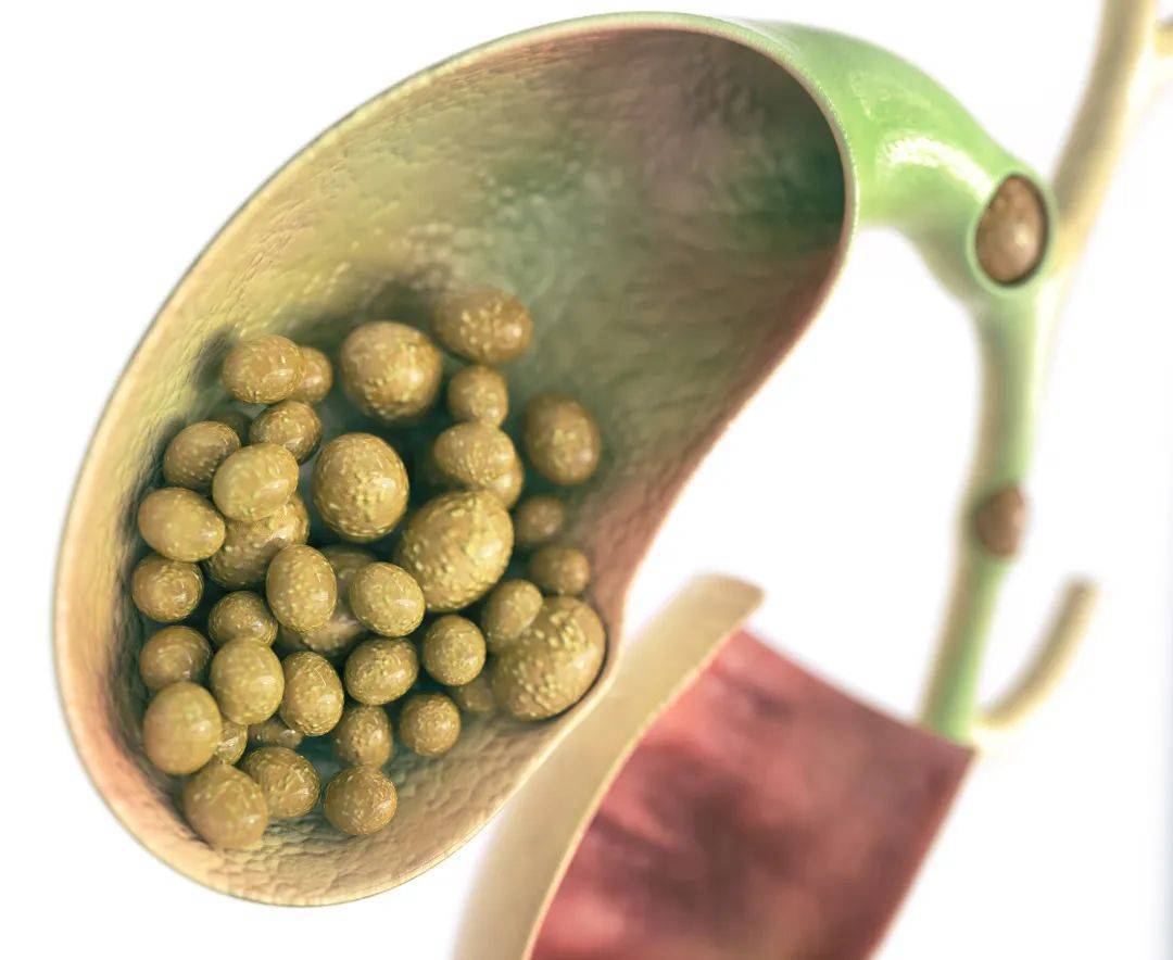 胆囊结石竟然"穿"到了小肠!_潘卫东_奶奶_广东省