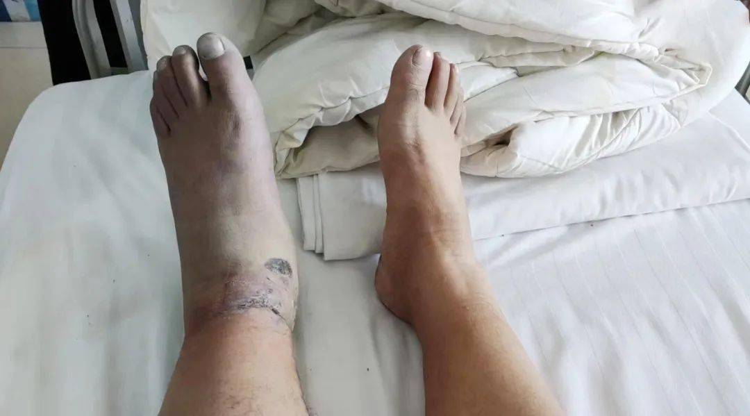 与"冷血杀手"骨筋膜室综合征的巅峰对决_患者_王志强_小腿