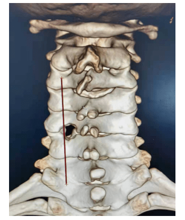 颈椎间盘ct图解图片