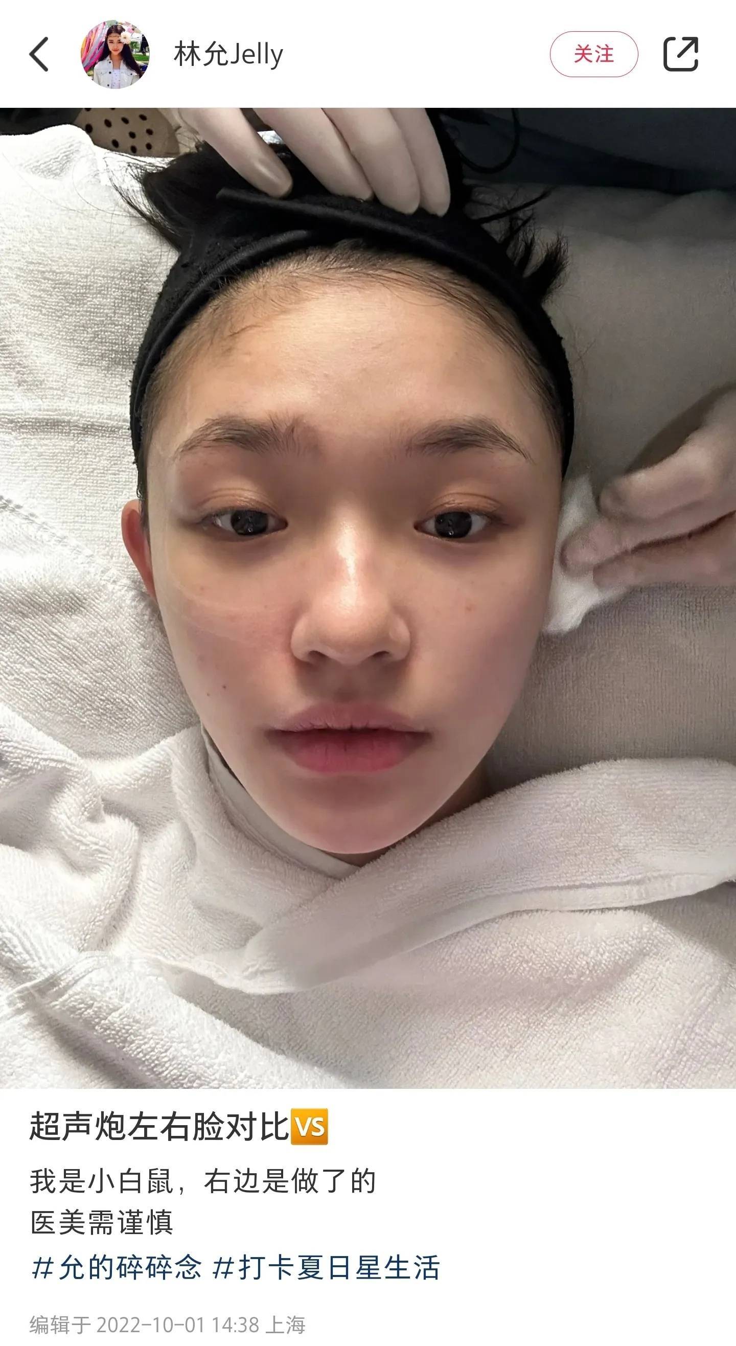 林允突然公开打针照打脸多少明星,一下子动两次脸是个牛人_陈浩民