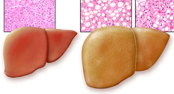 实锤了,每天4份水果加重脂肪肝,嘴里的葡萄,榴莲瞬间不香了_肝脏_果糖