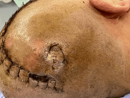 【病例分享】颅内耐碳青霉烯类鲍曼不动杆菌感染后硬膜下积液一例