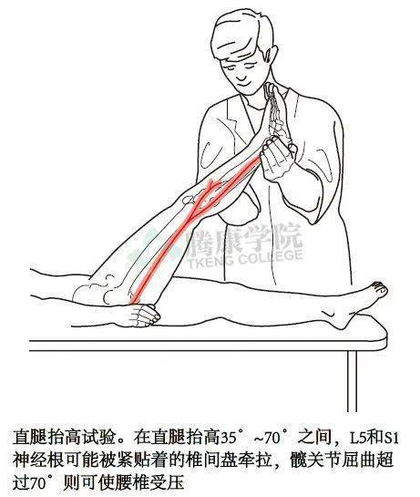 坐骨神经牵拉试验图片