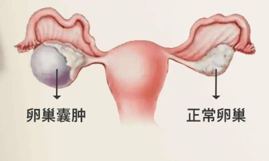 07 卵巢癌卵巢癌可引起腹部或盆腔痉挛,伴随着腿部和腰部疼痛.