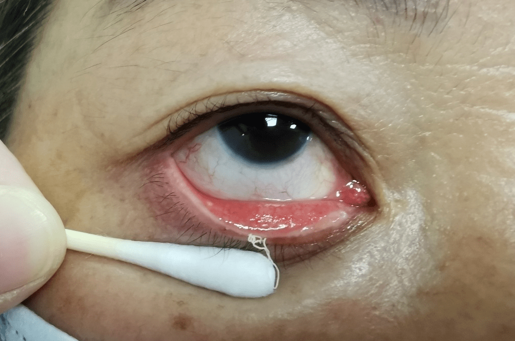 可以将通过热敷软化的油脂,以及堵塞的分泌物排出,从而疏通睑板腺分泌