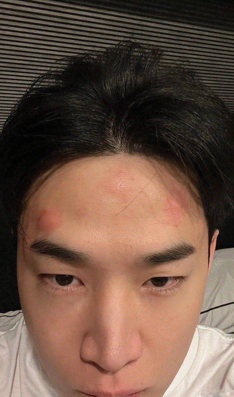 刘宪华晒自己被蚊子咬了满头包照片,看着就很痒,又可怜又好笑_直播