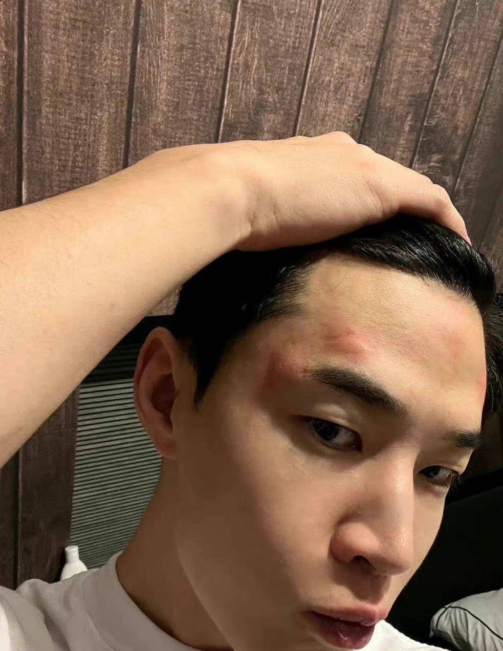 刘宪华晒自己被蚊子咬了满头包照片,看着就很痒,又可怜又好笑_直播