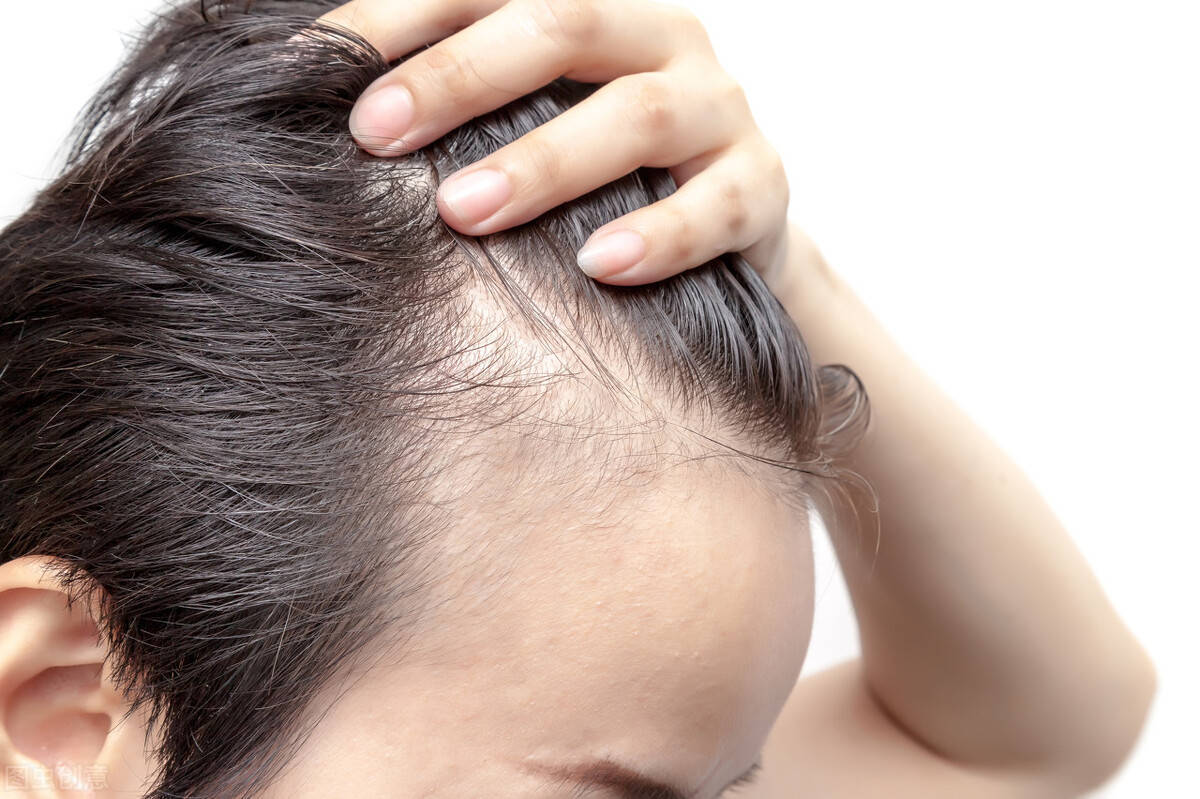 头皮干燥,营养不足或严重受伤害的毛囊逐渐萎缩,长出细小头发或不长