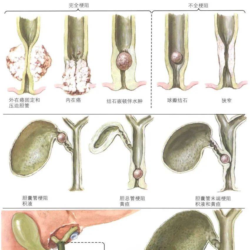 奈特图谱丨肝胆疾病~_胆管_病因_专题