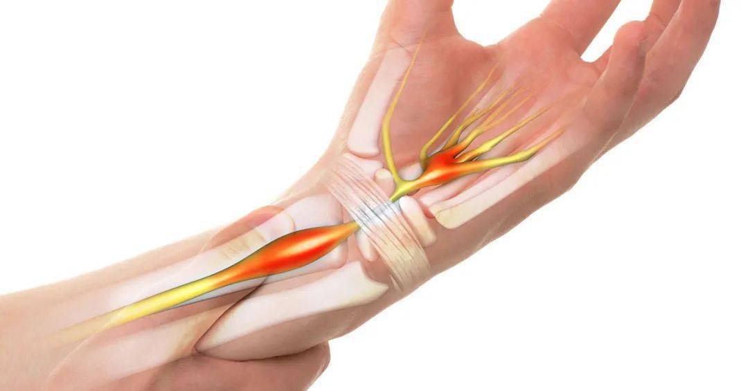 卡压引起的神经损伤的一个常见例子是腕管综合征,其特征是手腕和手指