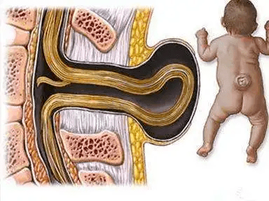 胎儿脊髓栓系图片