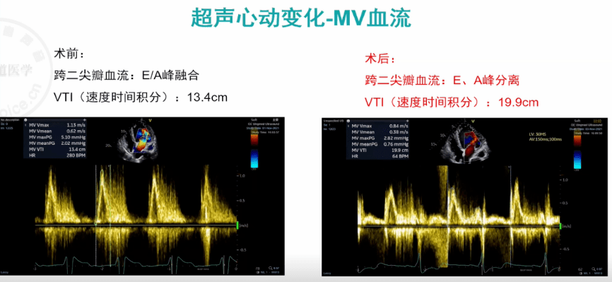 心讲座|朱天刚:pr显著延长合并qrs波增宽的心衰——crt治疗显奇效_左