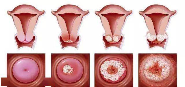 如女性患上子宫内膜炎,宫颈疾病以及阴道炎等,其中又以老年性的阴道炎