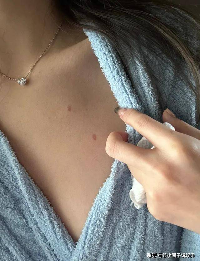 脸部受伤险破相,故意扯开衣服晒胸前伤痕_慎婕_身材_女生