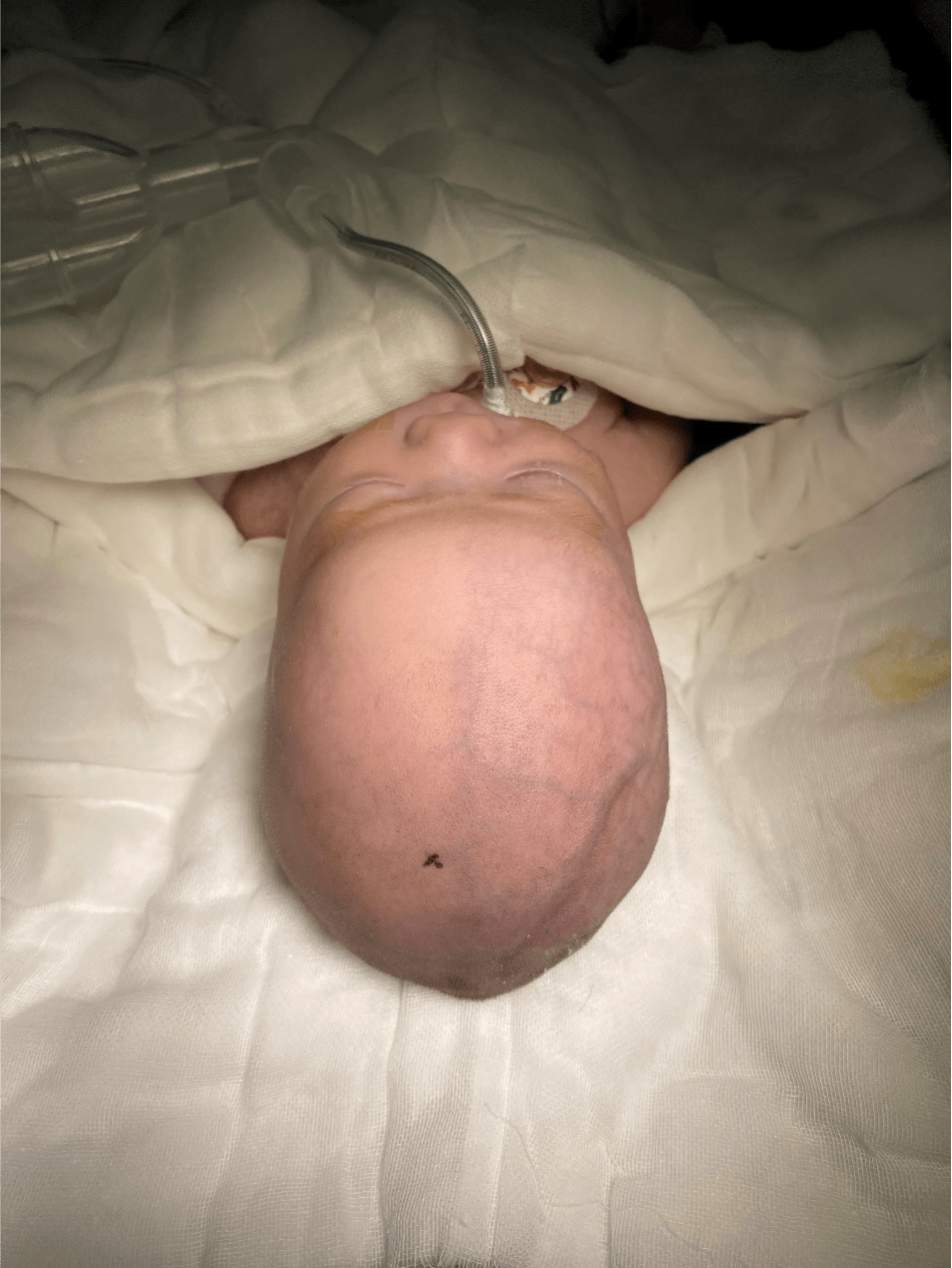 神经纤维瘤婴儿图片