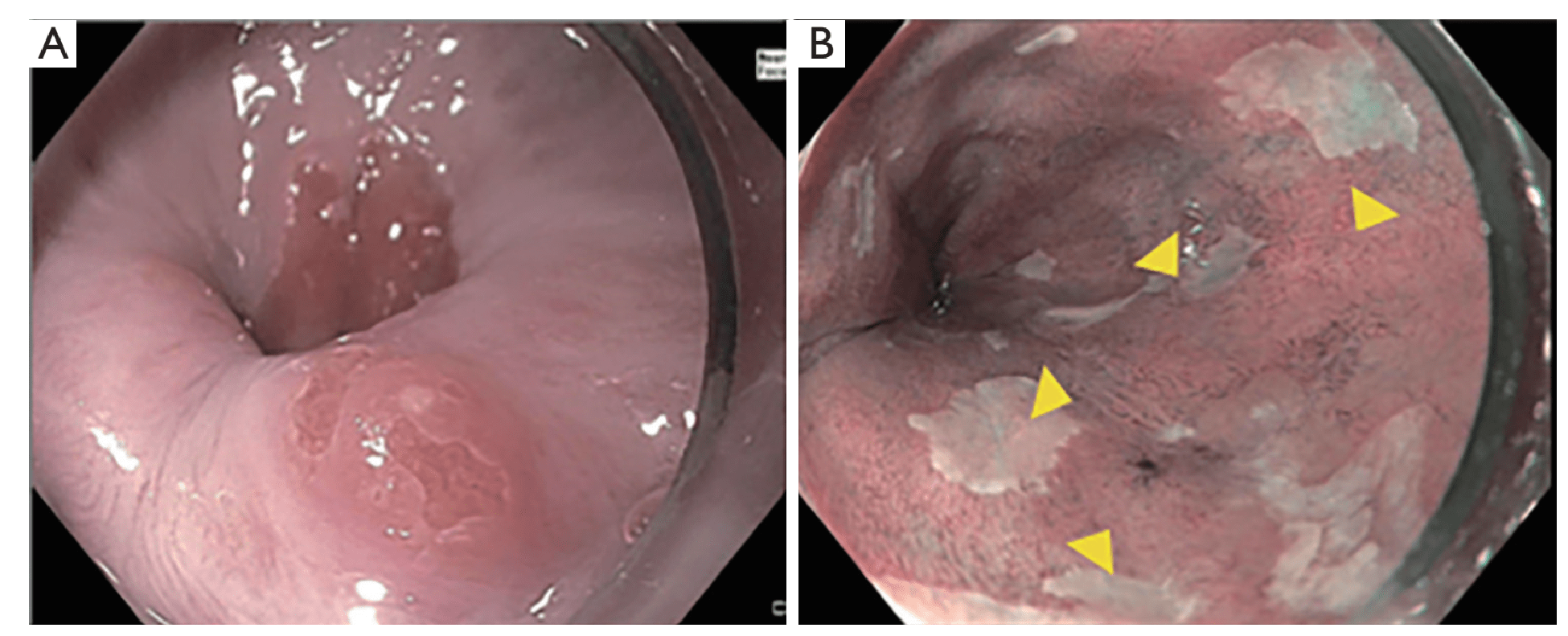一文明晰barrett食管内镜检查策略_检测_诊断_黏膜