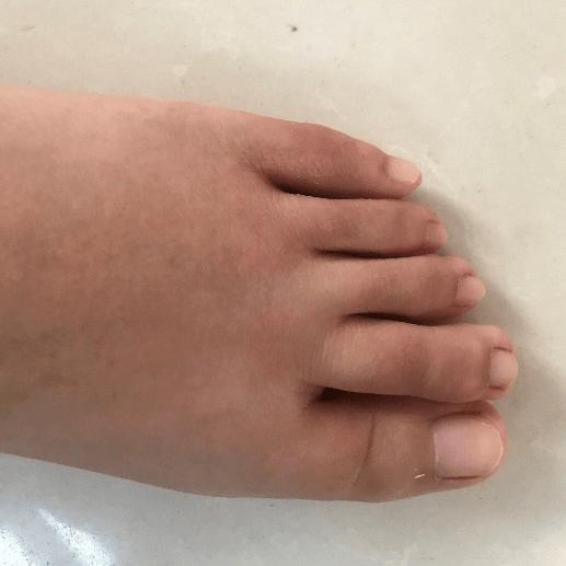 容易被误诊的关节炎——1例银屑病关节炎病例解析