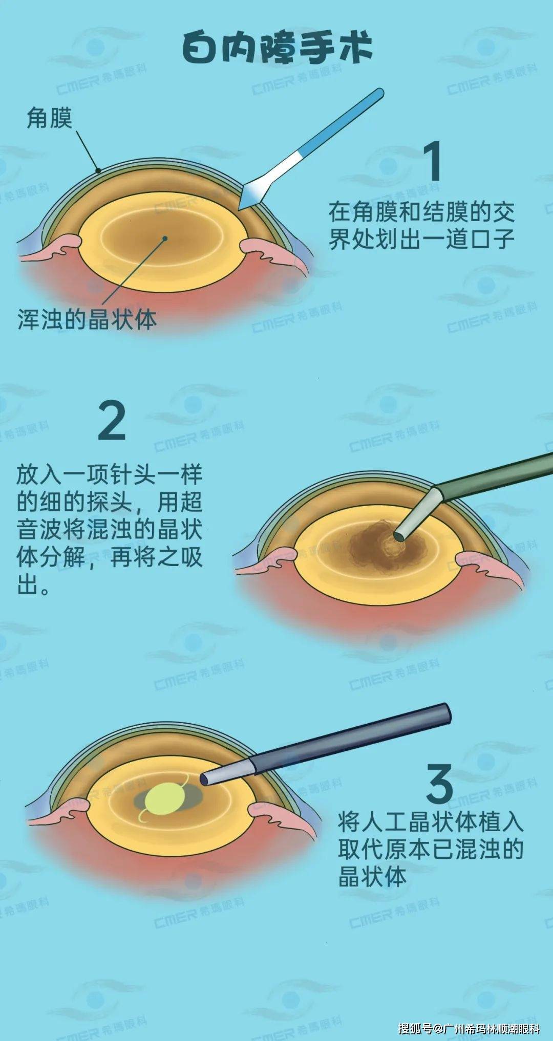 目力下降、致盲！那4类白内障谣言，让爸妈别再信啦！